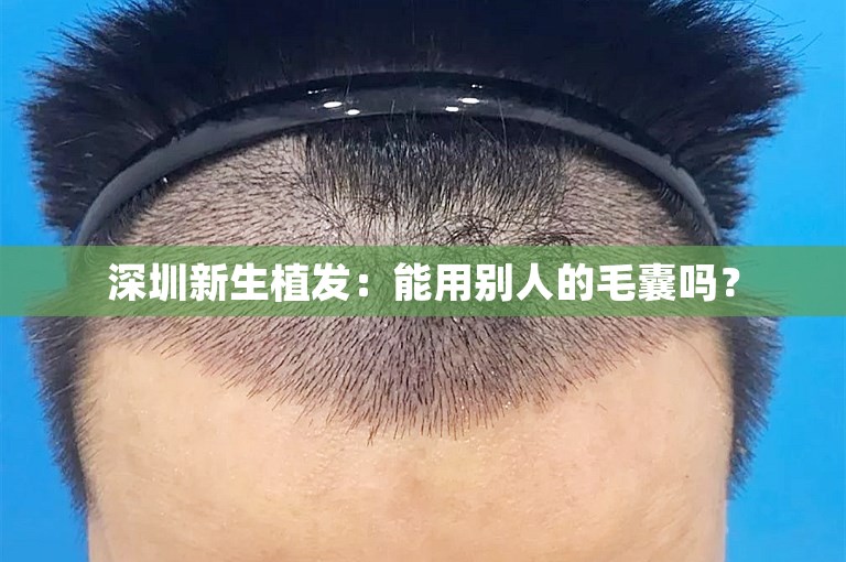 深圳新生植发：能用别人的毛囊吗？