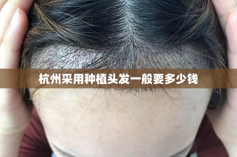 杭州采用种植头发一般要多少钱
