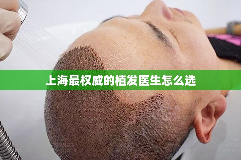上海最权威的植发医生怎么选