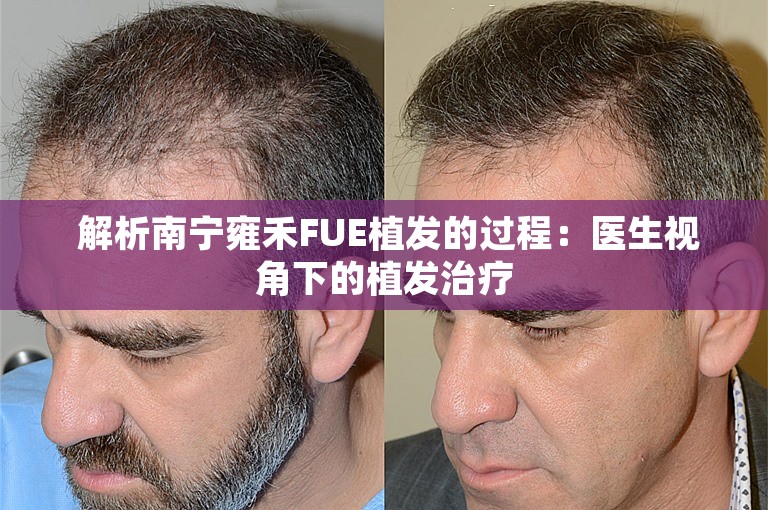  解析南宁雍禾FUE植发的过程：医生视角下的植发治疗