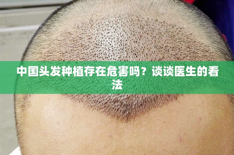 中国头发种植存在危害吗？谈谈医生的看法