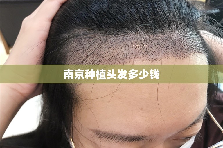 南京种植头发多少钱