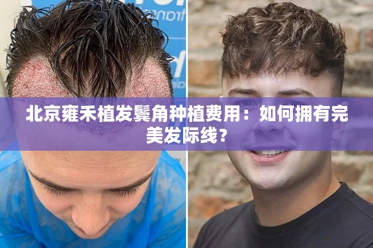 北京雍禾植发鬓角种植费用：如何拥有完美发际线？