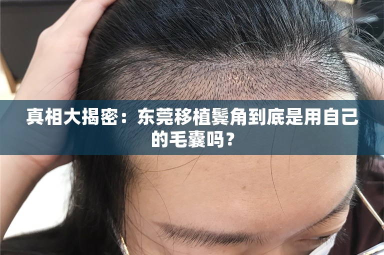 真相大揭密：东莞移植鬓角到底是用自己的毛囊吗？