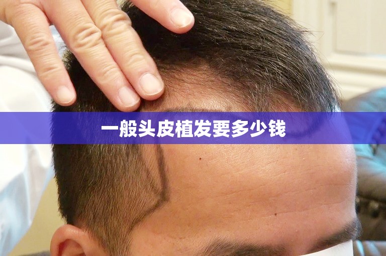 外国人如何选择专业的植发医生在温州