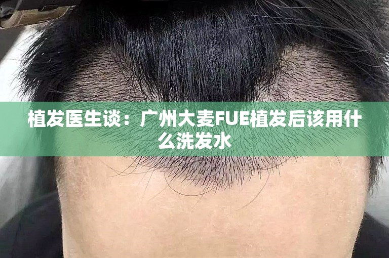 植发医生谈：广州大麦FUE植发后该用什么洗发水