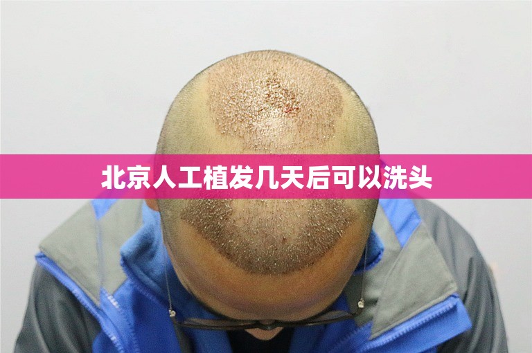 北京人工植发几天后可以洗头