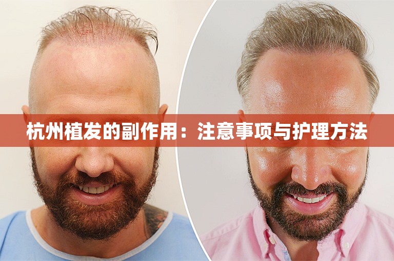 杭州植发的副作用：注意事项与护理方法