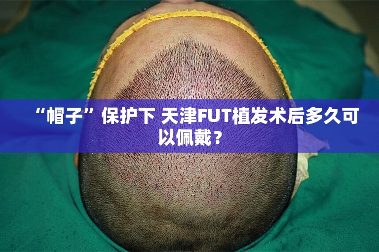 “帽子”保护下 天津FUT植发术后多久可以佩戴？