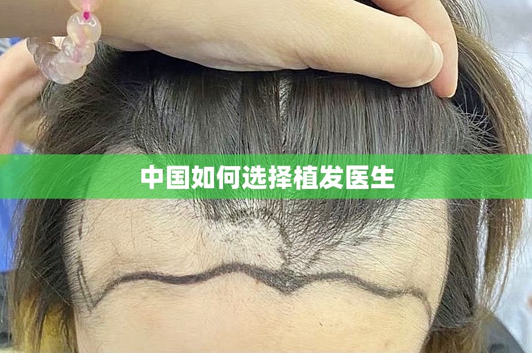 中国如何选择植发医生