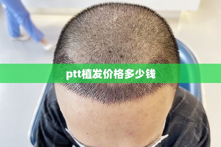 惠州头发种植好点的植发医院怎么选