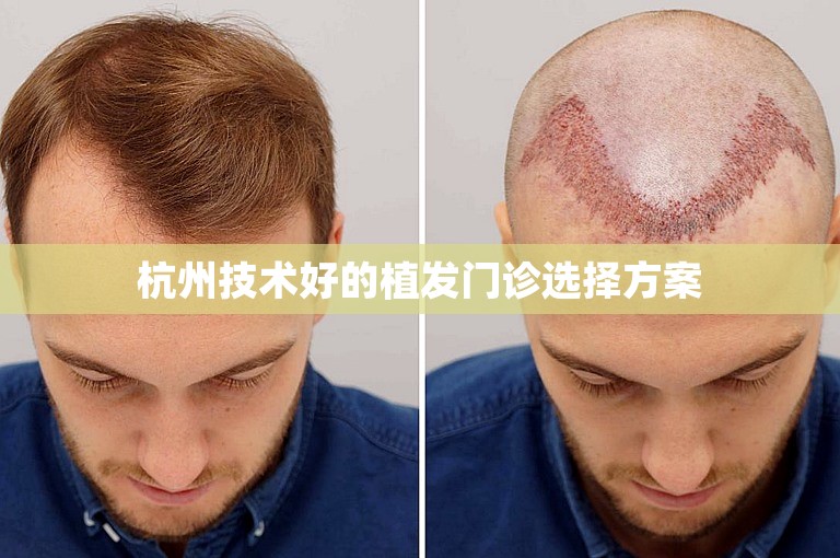 杭州技术好的植发门诊选择方案