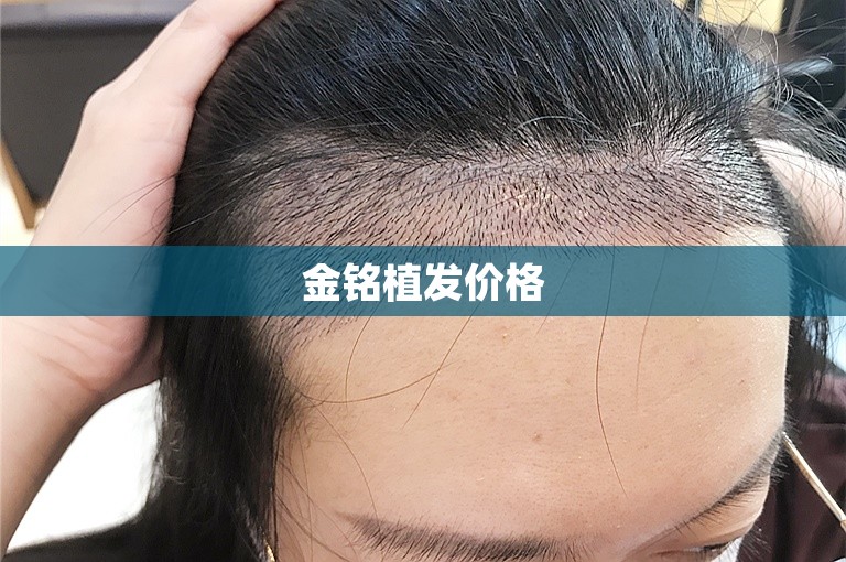 台州最安全的植发门诊选择攻略