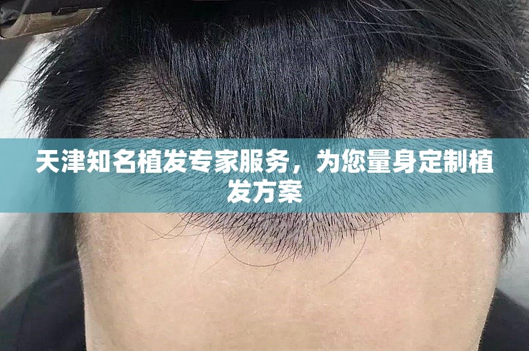 天津知名植发专家服务，为您量身定制植发方案