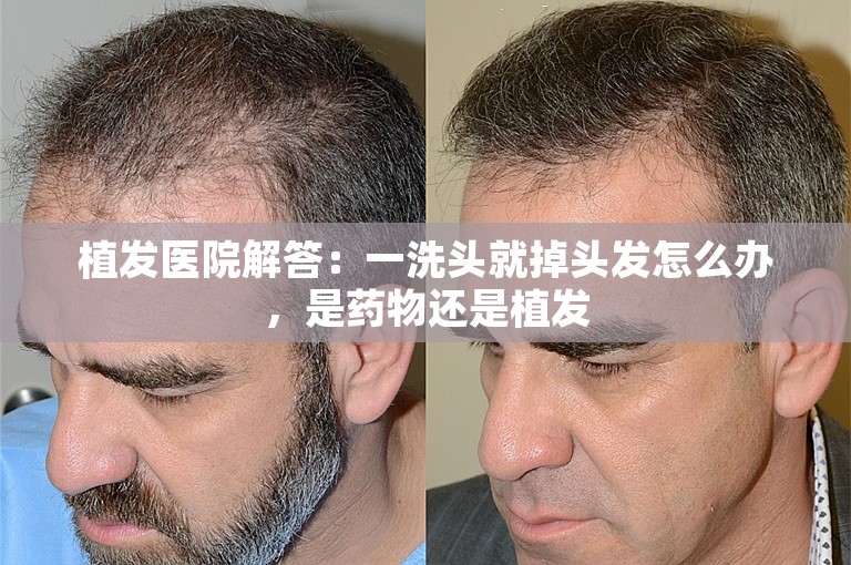 上海头发种植好点的植发专家选择攻略