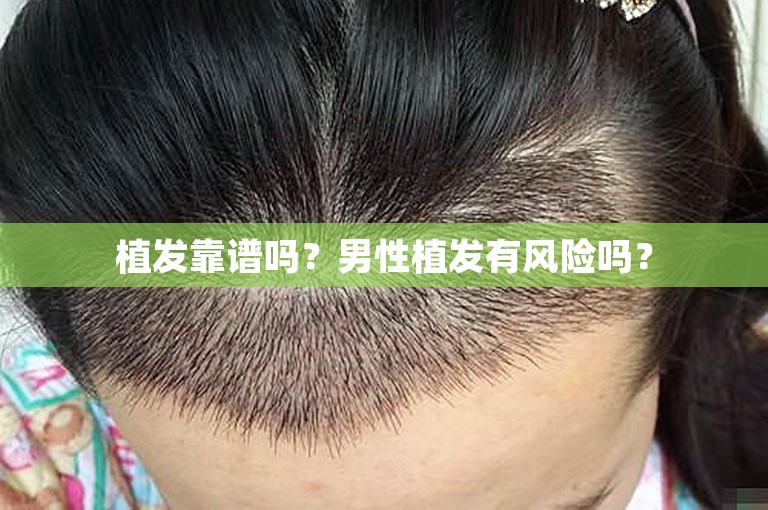 武汉头发种植好点的植发专家选择攻略