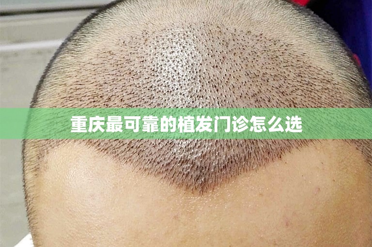 重庆最可靠的植发门诊怎么选