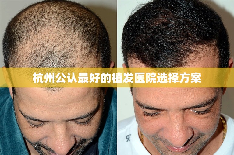 杭州公认最好的植发医院选择方案