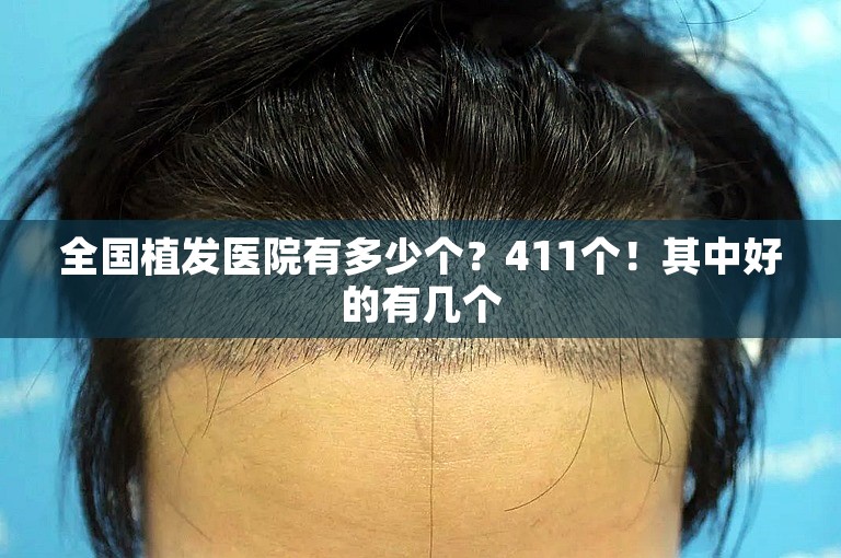 外国人如何选择植发医生在西安