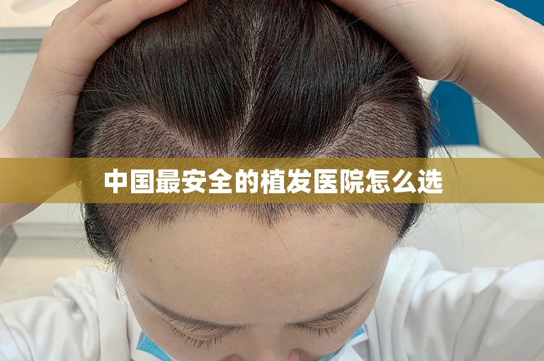 中国最安全的植发医院怎么选