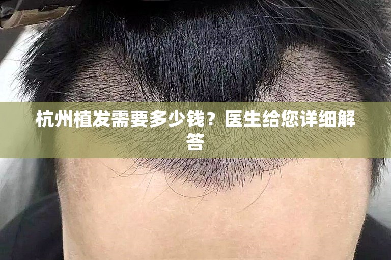 杭州植发需要多少钱？医生给您详细解答