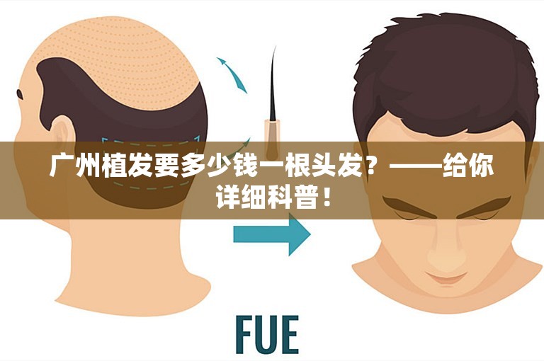 广州植发要多少钱一根头发？——给你详细科普！
