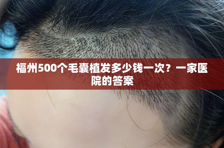 福州500个毛囊植发多少钱一次？一家医院的答案