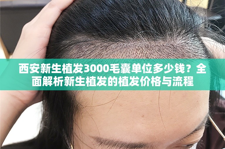 西安新生植发3000毛囊单位多少钱？全面解析新生植发的植发价格与流程