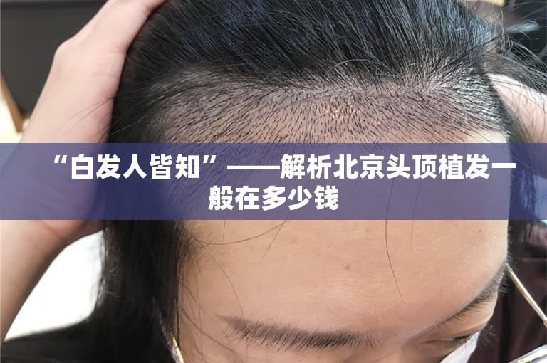 “白发人皆知”——解析北京头顶植发一般在多少钱