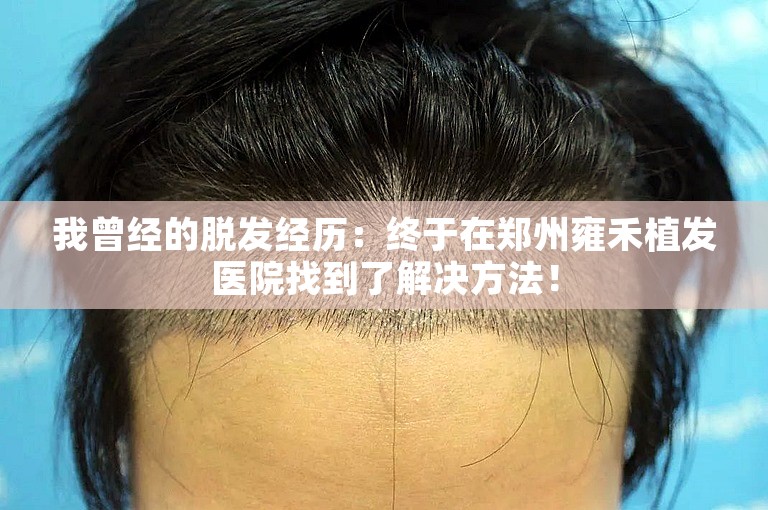 我曾经的脱发经历：终于在郑州雍禾植发医院找到了解决方法！