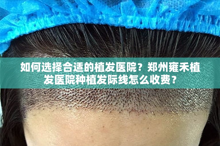 如何选择合适的植发医院？郑州雍禾植发医院种植发际线怎么收费？