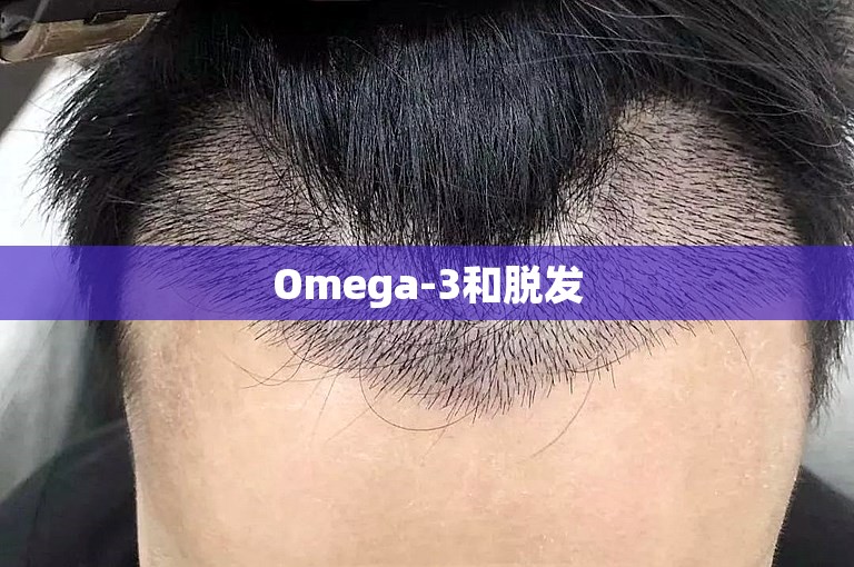 Omega-3和脱发