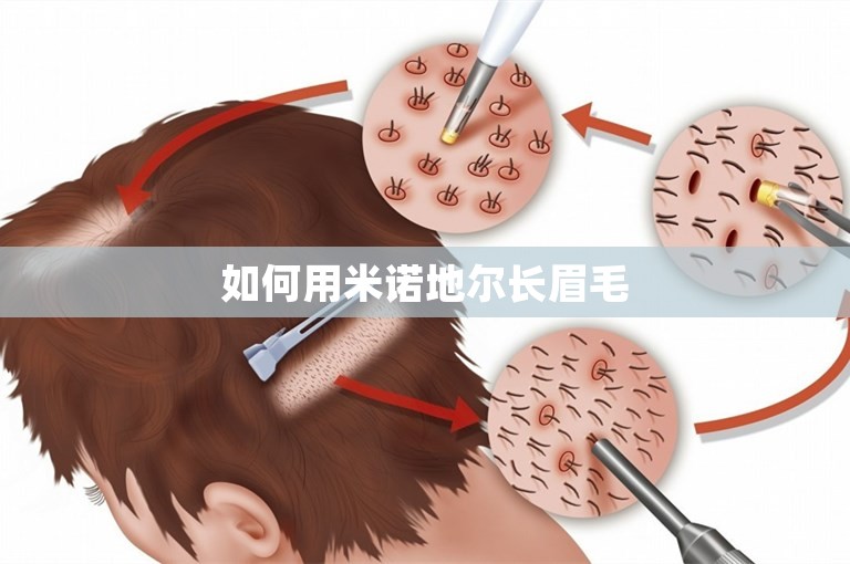 如何用米诺地尔长眉毛