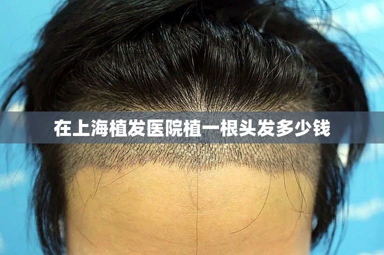 在上海植发医院植一根头发多少钱