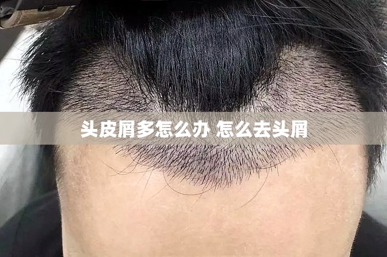 在广州种植头发多少钱