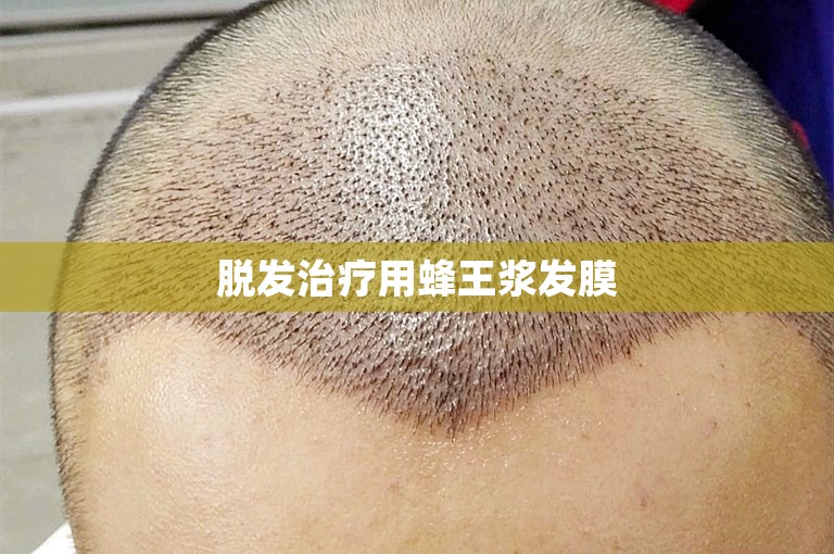 杭州植发的一般费用