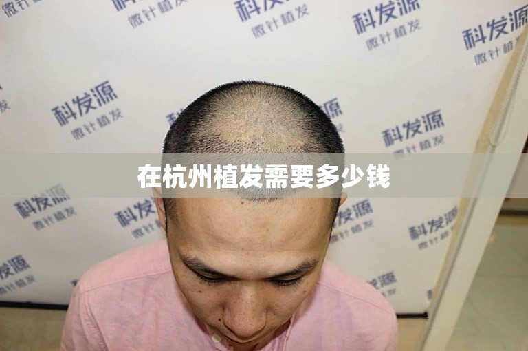 在杭州植发需要多少钱