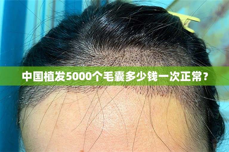 中国植发5000个毛囊多少钱一次正常？