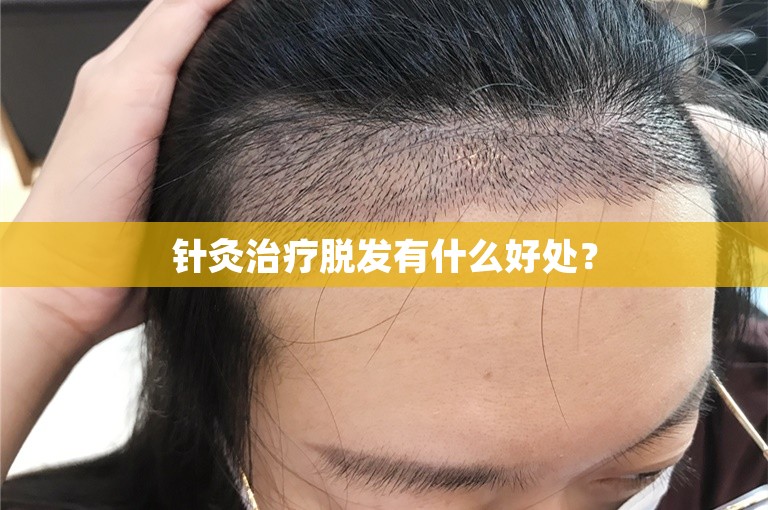 针灸治疗脱发有什么好处？