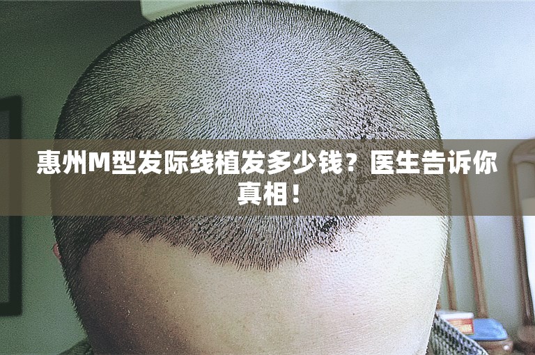 惠州M型发际线植发多少钱？医生告诉你真相！