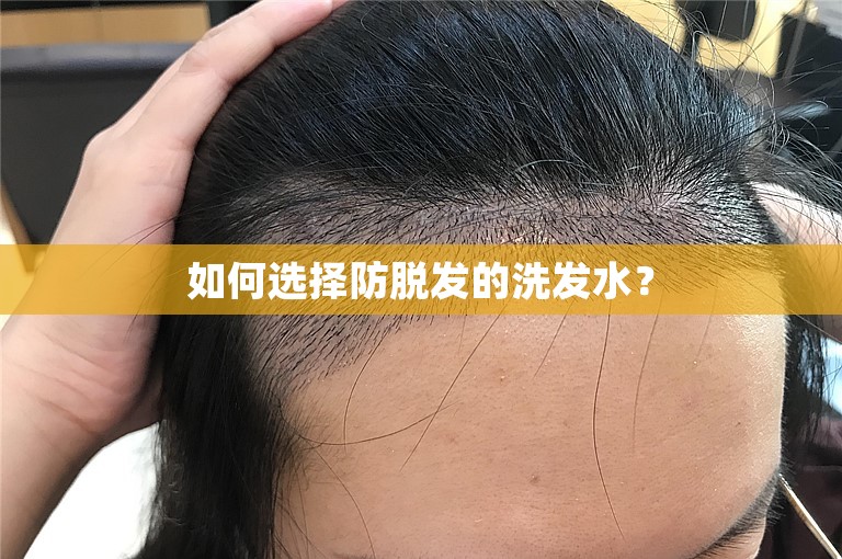 发际线植发费用大概需要多少钱？有效果吗？