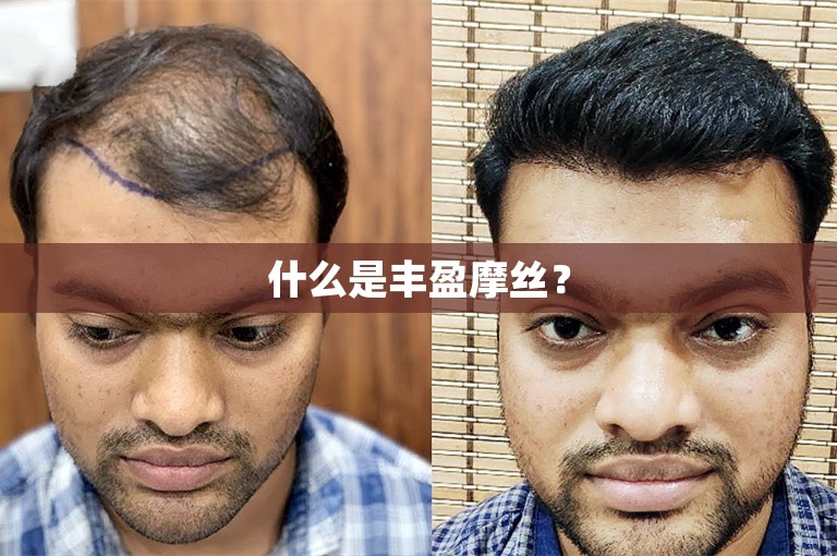 小疤痕植发需要多少钱？广州植发那家机构做的比较好？