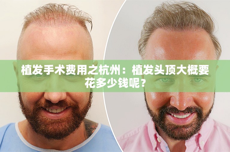 植发手术费用之杭州：植发头顶大概要花多少钱呢？