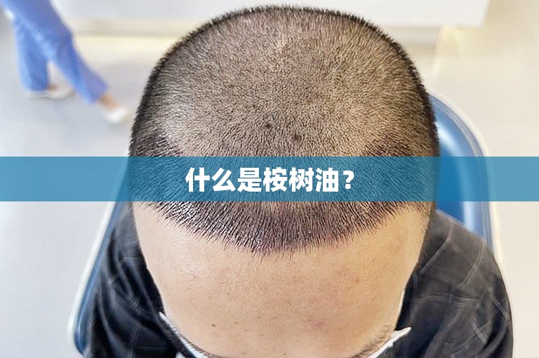 在上海种植头发要多少钱？