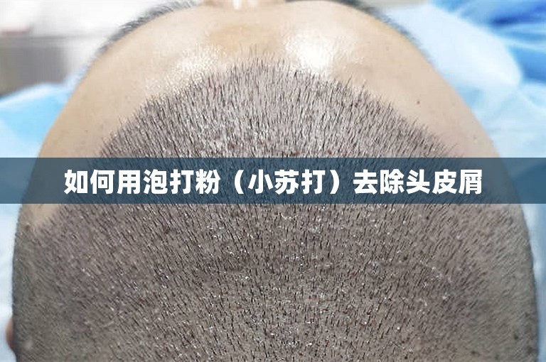 上海种植头发大概在多少钱
