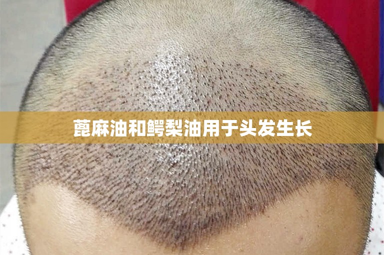 长标题：为什么越来越多人选择杭州植发？5000个毛囊价格不到0.8元，真的那么划算吗？