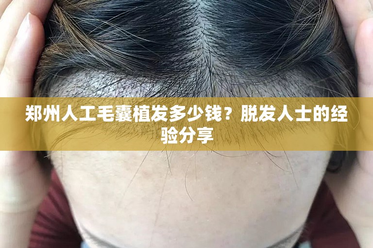 郑州人工毛囊植发多少钱？脱发人士的经验分享
