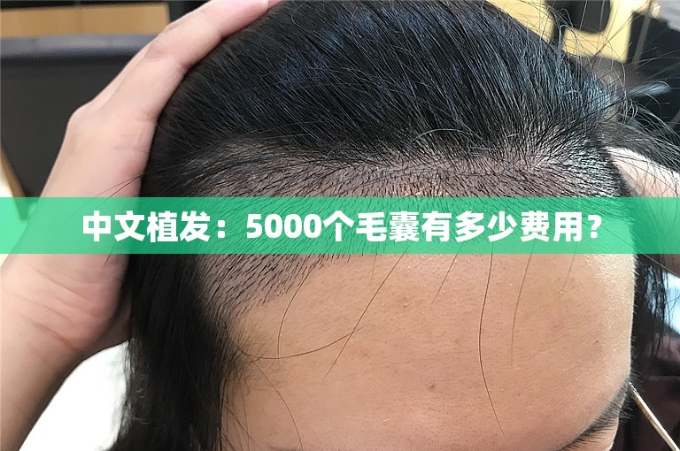 中文植发：5000个毛囊有多少费用？