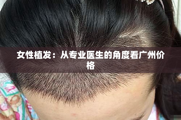 女性植发：从专业医生的角度看广州价格