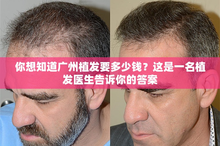你想知道广州植发要多少钱？这是一名植发医生告诉你的答案